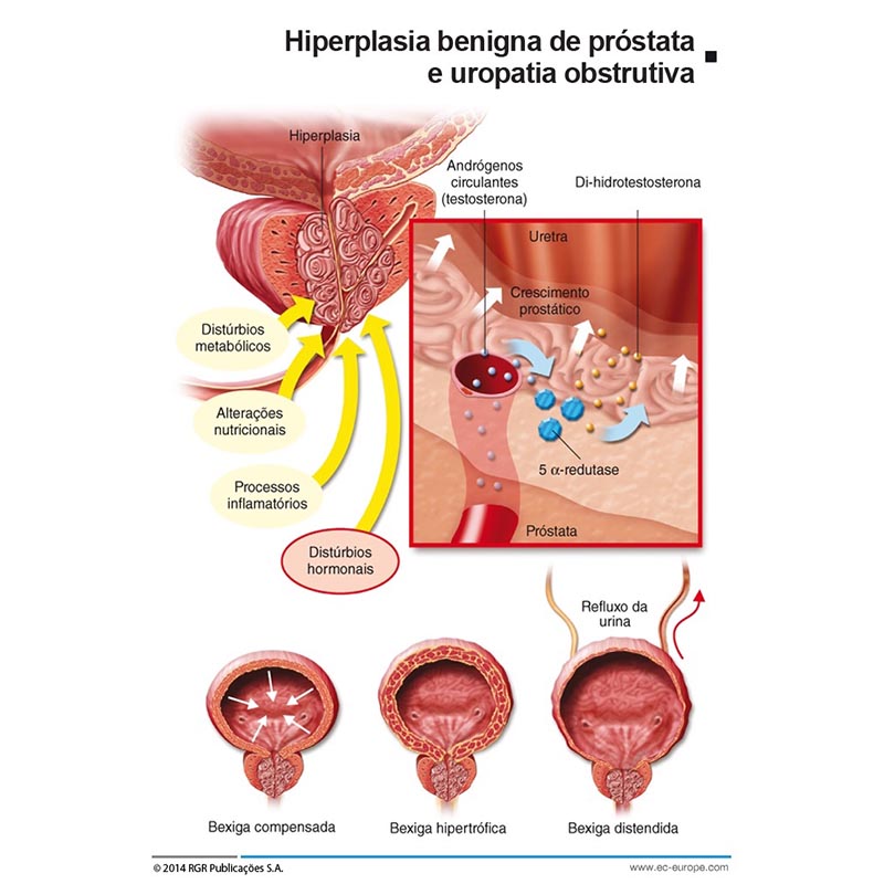 hiperplasia prostatica benigna pdf fisiopatologia