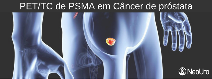 O que é o PET/TC de PSMA em câncer de próstata?