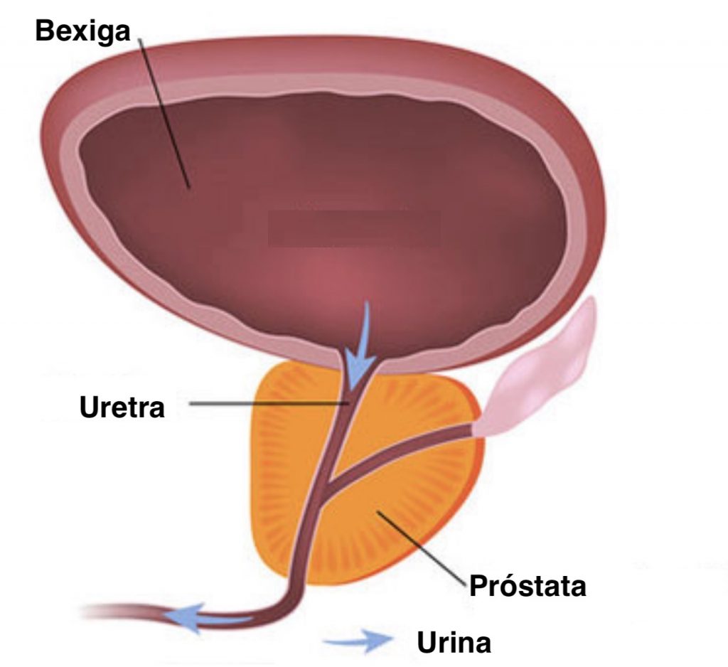 prostata inflamada cronica